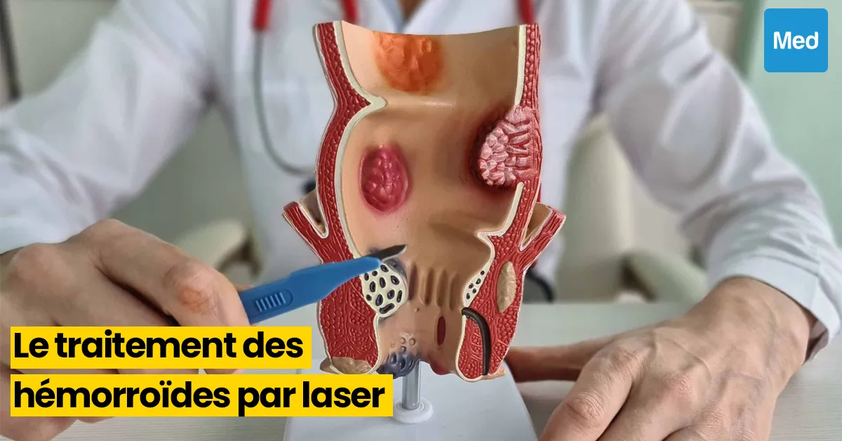 Révolution dans le Traitement des Hémorroïdes : La Thérapie au Laser